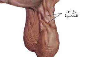 ما هي تأثيرات دوالي الخصيتين على الحمل والإنجاب؟دكتور عبدالعاطى المناعى 
